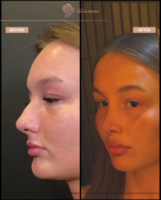 Barbie Nose Rhinoplasty Result