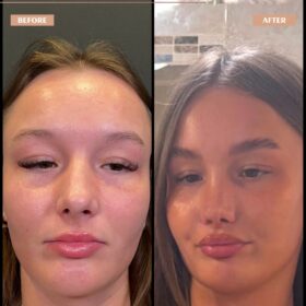 Barbie Nose Rhinoplasty Result Barbie Nose Rhinoplasty Result