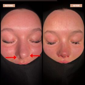 Barbie Nose Rhinoplasty Result Barbie Nose Rhinoplasty Result