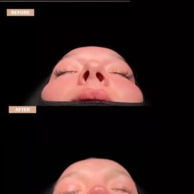 Barbie Nose Rhinoplasty Result Barbie Nose Rhinoplasty Result
