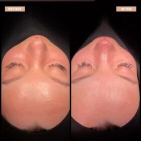 Barbie Nose Rhinoplasty Result Barbie Nose Rhinoplasty Result