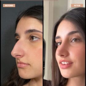 Big Nose Rhinoplasty Before & After Photos Big Nose Rhinoplasty Before & After Photos