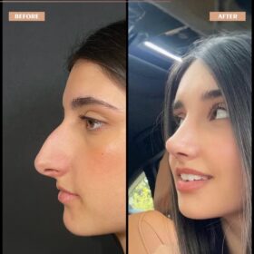 Big Nose Rhinoplasty Before & After Photos Big Nose Rhinoplasty Before & After Photos