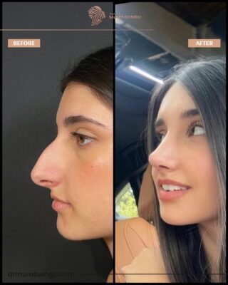 Big Nose Rhinoplasty Before & After Photos