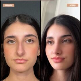 Big Nose Rhinoplasty Before & After Photos Big Nose Rhinoplasty Before & After Photos