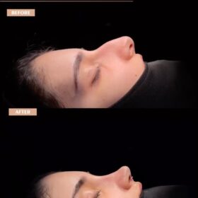Big Nose Rhinoplasty Before & After Photos Big Nose Rhinoplasty Before & After Photos