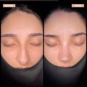Big Nose Rhinoplasty Before & After Photos Big Nose Rhinoplasty Before & After Photos