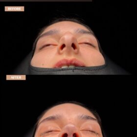 Big Nose Rhinoplasty Before & After Photos Big Nose Rhinoplasty Before & After Photos