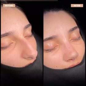 Big Nose Rhinoplasty Before & After Photos Big Nose Rhinoplasty Before & After Photos