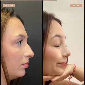 Cindy Nose Rhinoplasty Result Cindy Nose Rhinoplasty Result