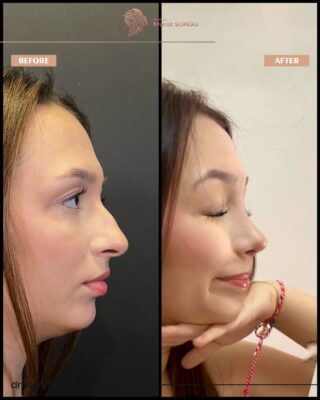 Cindy Nose Rhinoplasty Result