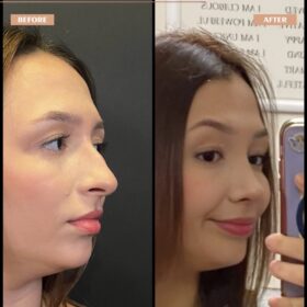 Cindy Nose Rhinoplasty Result Cindy Nose Rhinoplasty Result