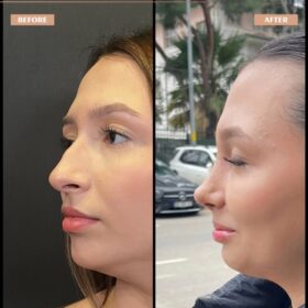 Cindy Nose Rhinoplasty Result Cindy Nose Rhinoplasty Result