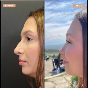 Cindy Nose Rhinoplasty Result Cindy Nose Rhinoplasty Result