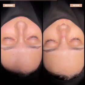 Cindy Nose Rhinoplasty Result Cindy Nose Rhinoplasty Result