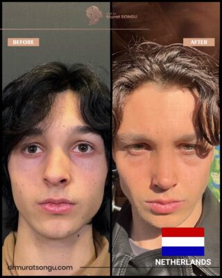 Crooked Nose Rhinoplasty Before & After Photos