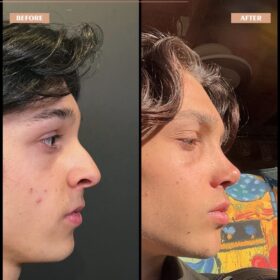 Crooked Nose Rhinoplasty Before & After Photos