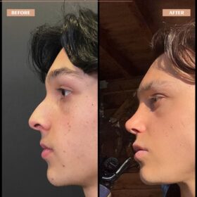 Crooked Nose Rhinoplasty Before & After Photos