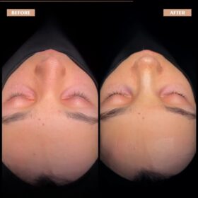 Crooked Nose Rhinoplasty Before & After Photos