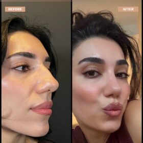 Female Big Nose Rhinoplasty Before & After Photos Female Big Nose Rhinoplasty Before & After Photos
