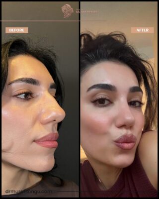 Female Big Nose Rhinoplasty Before & After Photos