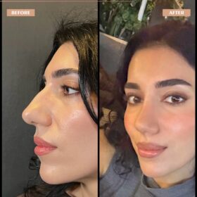 Female Big Nose Rhinoplasty Before & After Photos Female Big Nose Rhinoplasty Before & After Photos