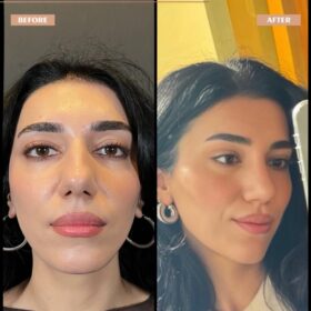 Female Big Nose Rhinoplasty Before & After Photos Female Big Nose Rhinoplasty Before & After Photos