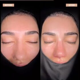 Female Big Nose Rhinoplasty Before & After Photos Female Big Nose Rhinoplasty Before & After Photos