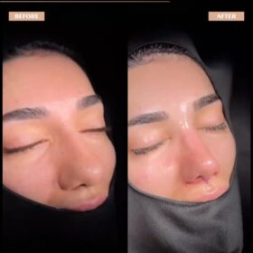 Female Big Nose Rhinoplasty Before & After Photos Female Big Nose Rhinoplasty Before & After Photos