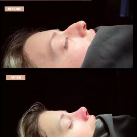 Female Droopy Tip Rhinoplasty Result Female Droopy Tip Rhinoplasty Result