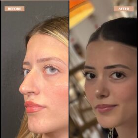 Female Droopy Tip Rhinoplasty Result Female Droopy Tip Rhinoplasty Result