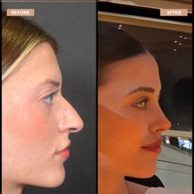 Female Droopy Tip Rhinoplasty Result Female Droopy Tip Rhinoplasty Result