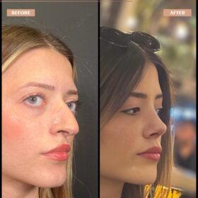 Female Droopy Tip Rhinoplasty Result Female Droopy Tip Rhinoplasty Result