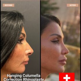 Hanging Columella Correction Rhinoplasty Result Hanging Columella Correction Rhinoplasty Result