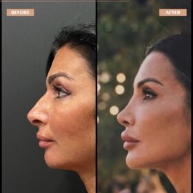 Hanging Columella Correction Rhinoplasty Result Hanging Columella Correction Rhinoplasty Result