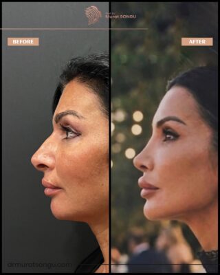 Hanging Columella Correction Rhinoplasty Result