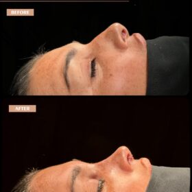 Hanging Columella Correction Rhinoplasty Result Hanging Columella Correction Rhinoplasty Result