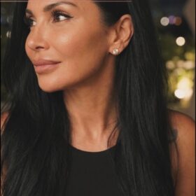 Hanging Columella Correction Rhinoplasty Result Hanging Columella Correction Rhinoplasty Result