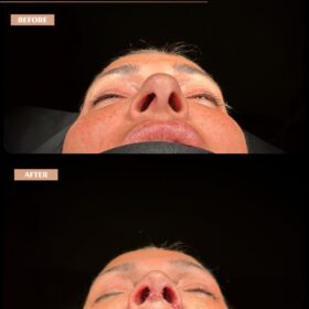 Hanging Columella Correction Rhinoplasty Result Hanging Columella Correction Rhinoplasty Result