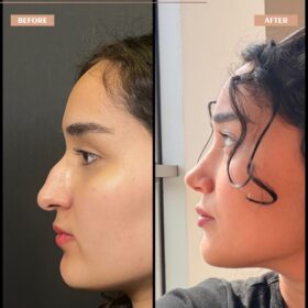 Hooked Nose Rhinoplasty Before & After Photos Hooked Nose Rhinoplasty Before & After Photos