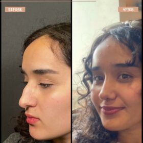 Hooked Nose Rhinoplasty Before & After Photos Hooked Nose Rhinoplasty Before & After Photos
