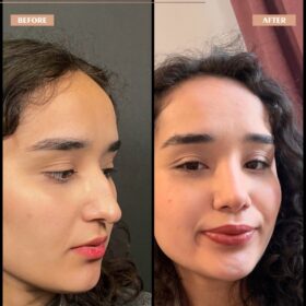 Hooked Nose Rhinoplasty Before & After Photos Hooked Nose Rhinoplasty Before & After Photos