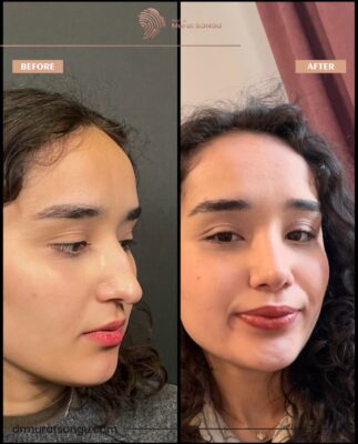 Hooked Nose Rhinoplasty Before & After Photos