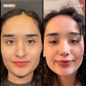 Hooked Nose Rhinoplasty Before & After Photos Hooked Nose Rhinoplasty Before & After Photos
