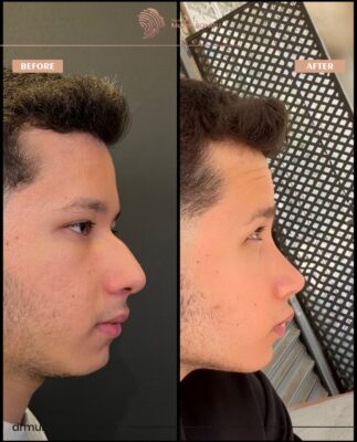 Male Deep Radix Rhinoplasty Result