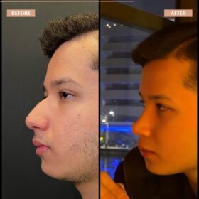 Male Deep Radix Rhinoplasty Result Male Deep Radix Rhinoplasty Result