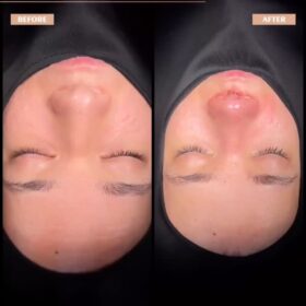 Male Deep Radix Rhinoplasty Result Male Deep Radix Rhinoplasty Result