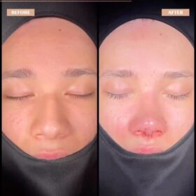 Male Deep Radix Rhinoplasty Result Male Deep Radix Rhinoplasty Result