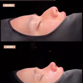 Male Deep Radix Rhinoplasty Result