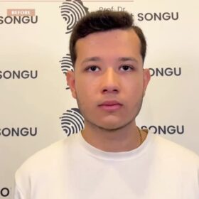 Male Deep Radix Rhinoplasty Result